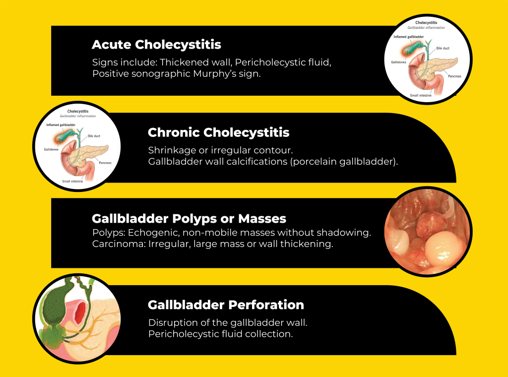 GALLBLADDER ABNOMALITIES 2