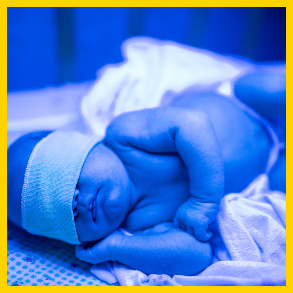 newborn jaundice 3