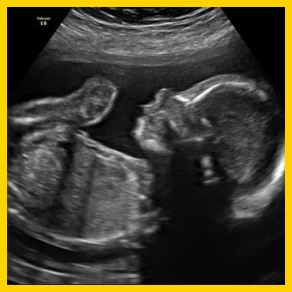 2d ultrasound